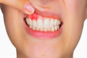 O que causa inchaço na gengiva?