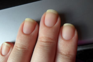 Unhas Amareladas: Quais são as causas?