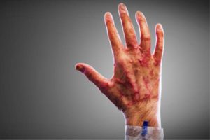 Dicas Caseiras Para Aliviar As Queimaduras