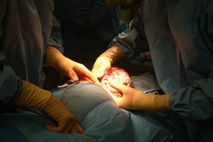 Posso fazer a laqueadura após a cesária?