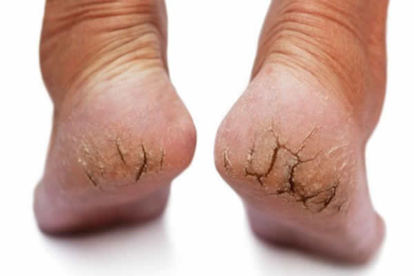 Como evitar a pele dos pés de ficar rachada?